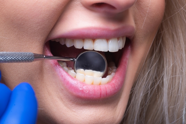 How Dental Fillings Can Improve Your Oral Health