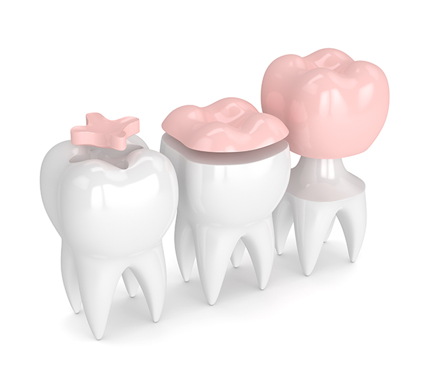 Atlanta Dental Inlays and Onlays