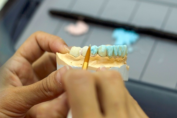 FAQs About Full Mouth Reconstruction