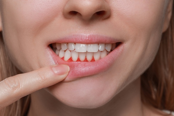 Gingivitis To Periodontitis: The Stages Of Gum Disease
