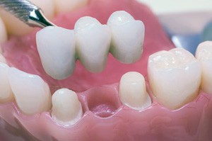 A Dental Bridge replaces missing teeth